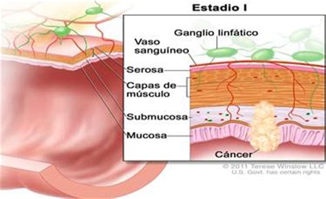 Cancer de Colon:  El estigma oculto    Monografias.com