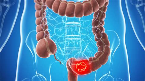 Cáncer de colon: un nuevo protocolo aumenta las chances de ...