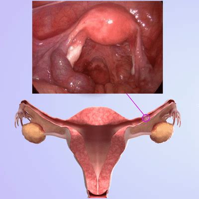 Cáncer de cuello uterino  cervical : causas y síntomas