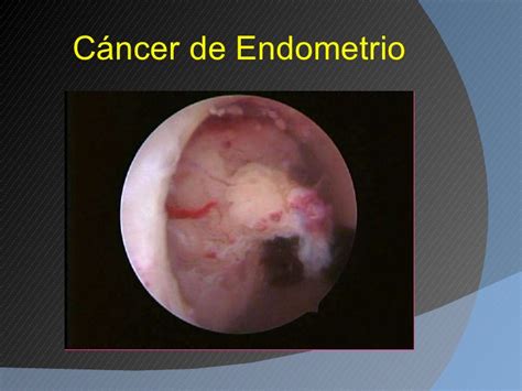 Cancer De Endometrio Related Keywords   Cancer De ...