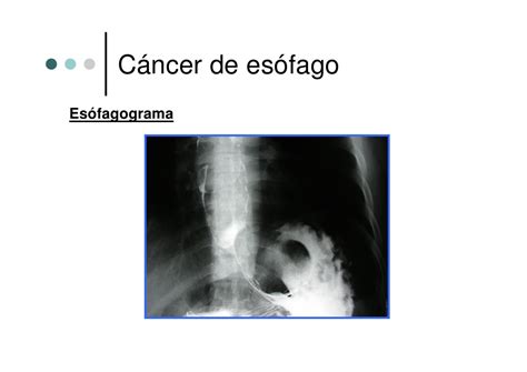 cancer de esofago c 225 ncer de esofago