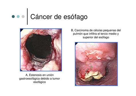 cáncer de esofago