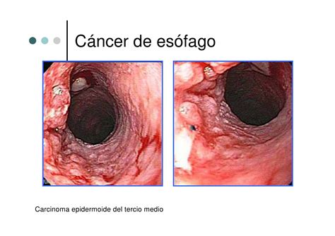 cáncer de esofago