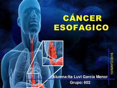 Cancer de esofago