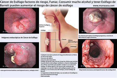 Cáncer de Esófago   Notas Sobre Gastroenterología ...