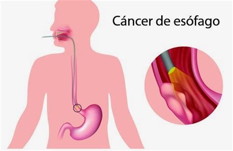Cancer de esófago: síntomas y tratamientos | Salud y Cuidados