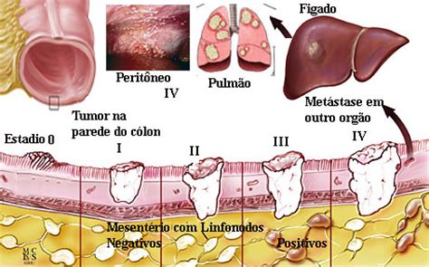 Câncer de intestino   Dr. Derival Santos   Coloproctologia ...