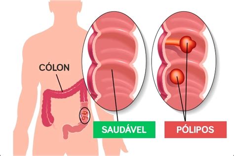 Câncer de intestino: sintomas   Tua Saúde