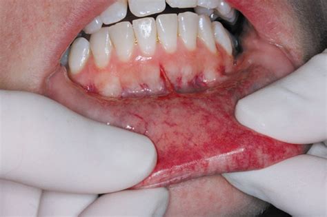 Cancer de labio y de cavidad oral