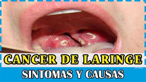 Cáncer de laringe y faringe, síntomas y causas.   YouTube