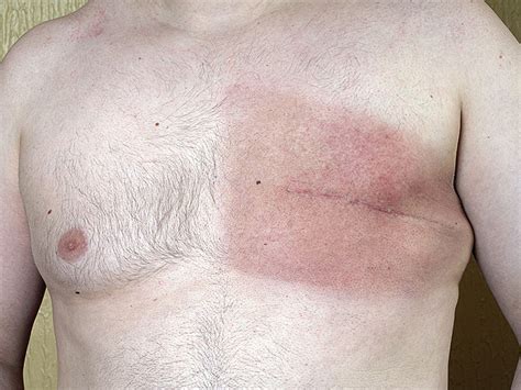 Câncer de mama em homens: Sintomas e tratamentos   Tudo ...