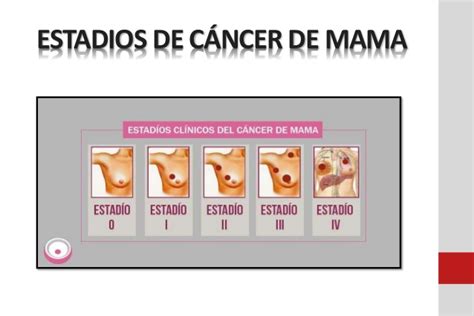 Cancer de mama