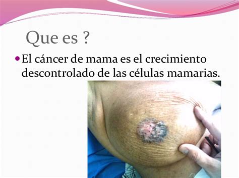 cancer de mama