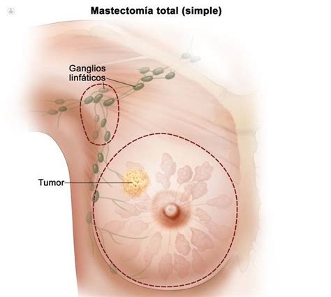 Cáncer de mama: tipos, cirugía y tratamiento