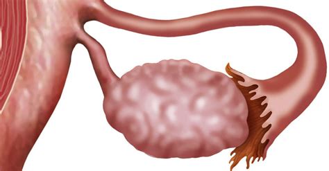 Cáncer de ovario | Enfermedades y patologías | MedicinaTV
