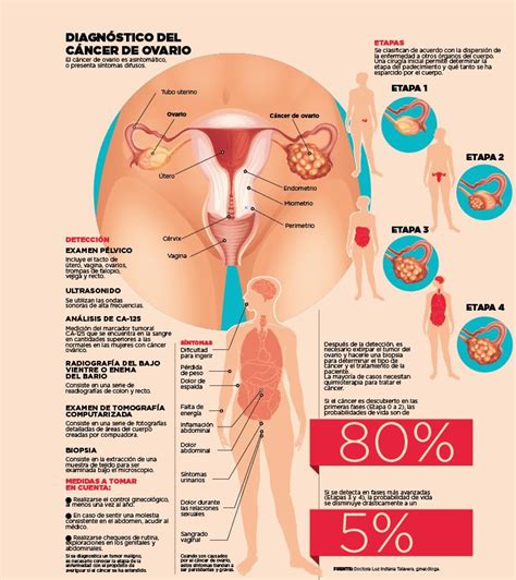 Cáncer de ovario, un peligro silencioso • El Nuevo Diario
