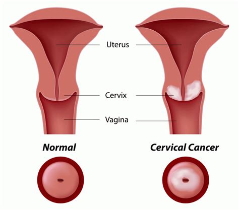 Cancer de Ovarios: Causas, sintomas, causas, tratamientos ...
