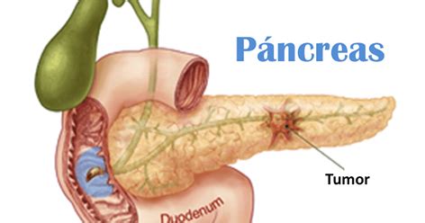 Cáncer de páncreas: 5 Señales de alerta que debes conocer ...