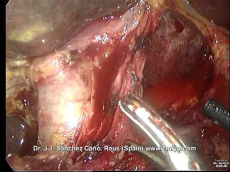 Cáncer de páncreas. DPC por laparoscopia. 1ª parte   YouTube