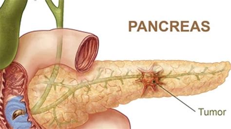 CANCER DE PANCREAS | Especial Cáncer