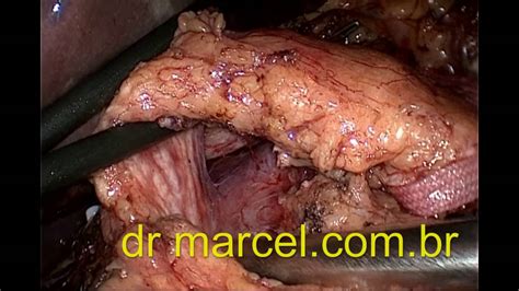 Cancer de Pancreas Pancreatectomia total por ...