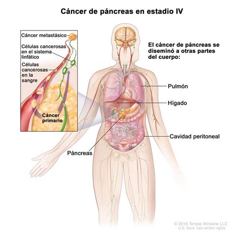 Cáncer de páncreas  PDQ® —Versión para pacientes ...