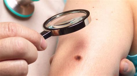 Cáncer de piel: melanoma, no melanoma, síntomas, causas y ...