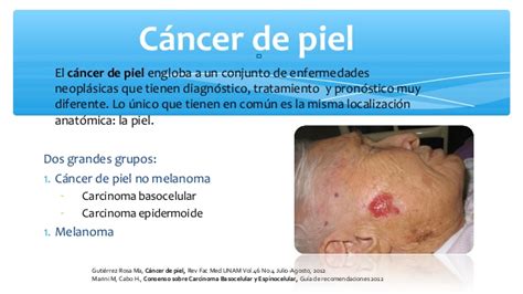 Cancer de piel Nieves Fernandez