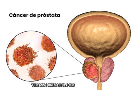 Cáncer de Próstata   10 Respuestas que Debes Conocer