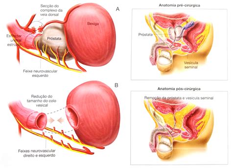 Câncer de Próstata – Próstata   Cirurgia Robótica