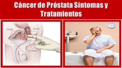 Cáncer de Próstata Sintomas | Signos y Tratamientos del ...