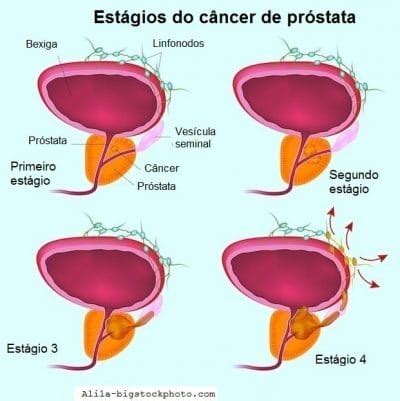 Câncer de próstata, sintomas, tratamento, mortalidade e ...