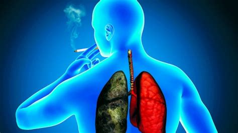Cáncer de pulmón, causas, síntomas y tratamiento