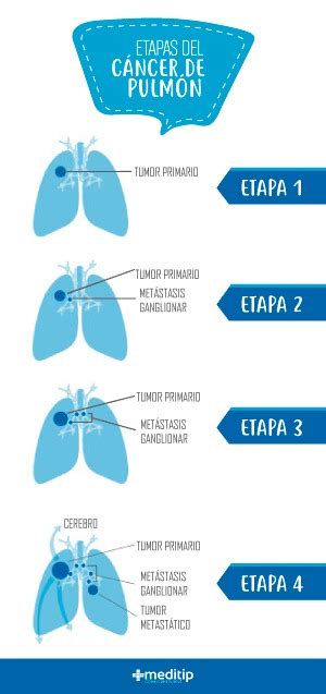 Cáncer de pulmón: causas y síntomas tempranos   Meditip