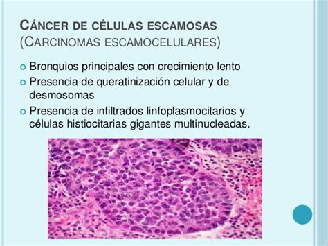cancer de pulmon celulas pequeñas y no pequeñas tumores de ...