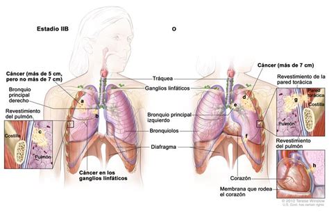 Cáncer de pulmón de células no pequeñas  PDQ® —Versión ...
