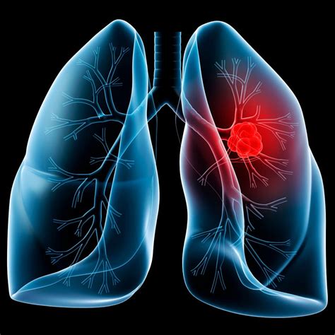 Cáncer de pulmón, el más mortal de todos | Sinapsis MX