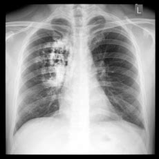 Cáncer de pulmón: MedlinePlus en español