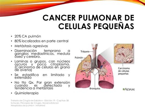 Cancer de pulmón