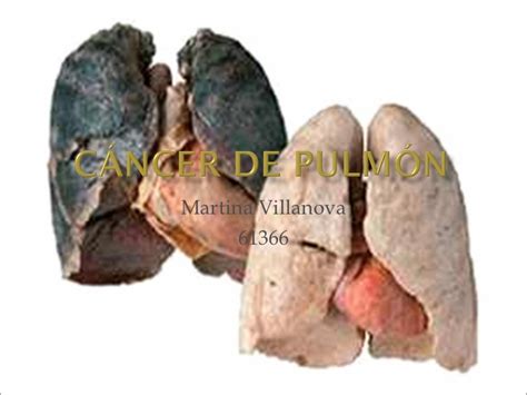 Cancer De Pulmon Related Keywords   Cancer De Pulmon Long ...