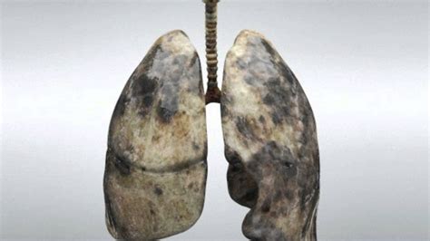 Cáncer de pulmón | Síntomas, tipos, detección, pronóstico ...