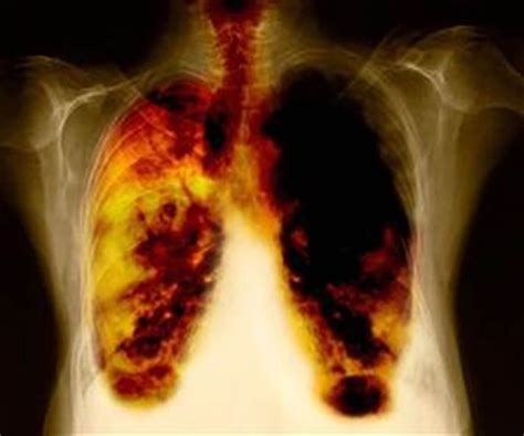 Cancer de pulmon   Taringa!