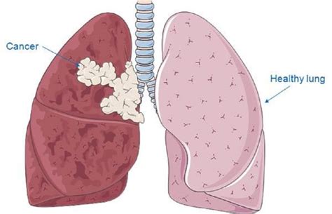 Cáncer de pulmón: Test para la detección