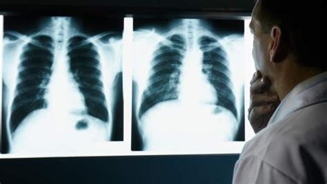 Cáncer de pulmón y tos: ¿cuál es la conexión?