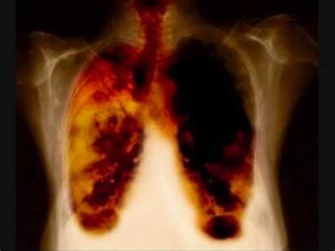 Cáncer de pulmón   YouTube