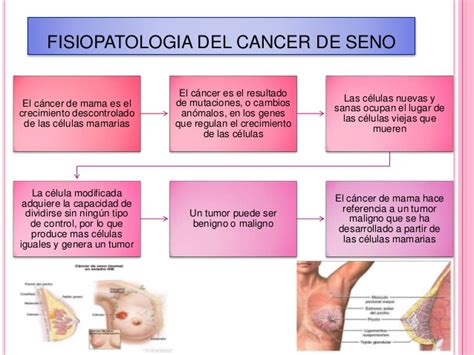 cancer de seno