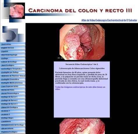 Cáncer del Colon  Gastroenterologia El Salvador ...