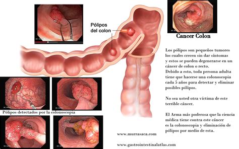 Cáncer del Colon Gastroenterologia El Salvador ...