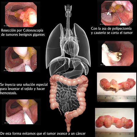Cáncer del Colon  Gastroenterologia El Salvador ...