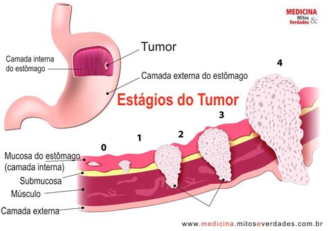 Cancer Gastrico Fase | LaceandPromises